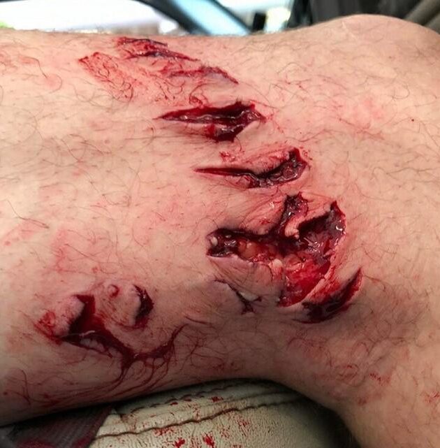 Bite mark helps experts determine this shark species bit woman on popular New York beach – FOX Weather
