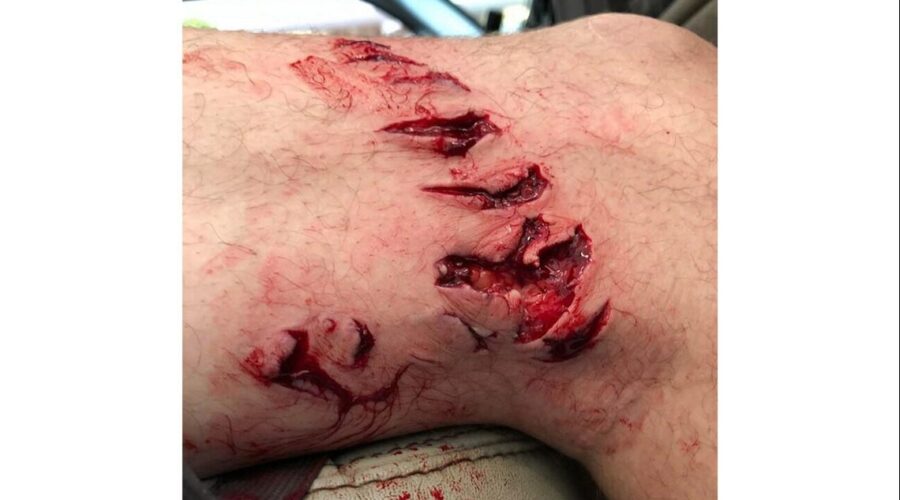 Bite mark helps experts determine this shark species bit woman on popular New York beach – FOX Weather