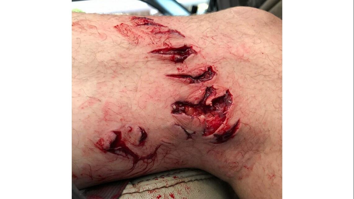 Bite mark helps experts determine this shark species bit woman on popular New York beach – FOX Weather